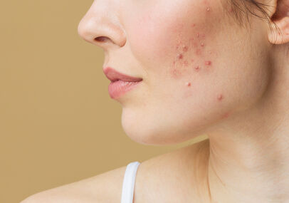Laisser sa peau tranquille&nbsp;: ne pas toucher aux boutons sur le visage