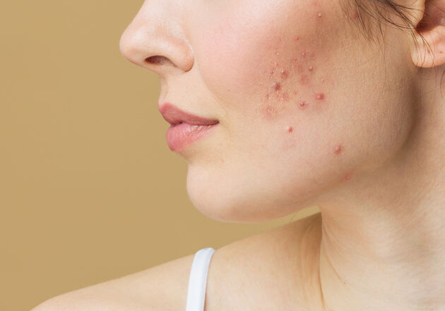 Laisser sa peau tranquille&nbsp;: ne pas toucher aux boutons sur le visage